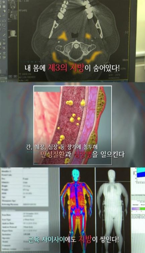 ⓒ KBS '생로병사의 비밀' 방송 화면