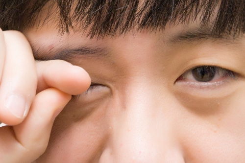 [건강 Tip] 시력과 눈건강에도 영향을 미치는 안검하수