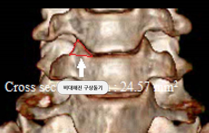 경추협착증 환자 3D CT: 비대해진 구상돌기 단면적