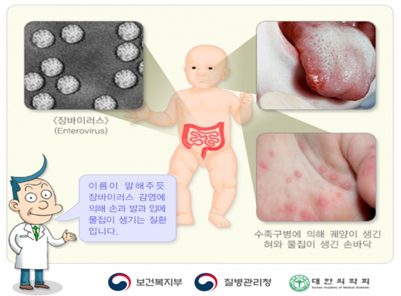 수족구병 병변 모습 / 이미지 출처 : 질병관리청