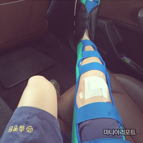 ▲깁스를한안신애의오른쪽다리.사진