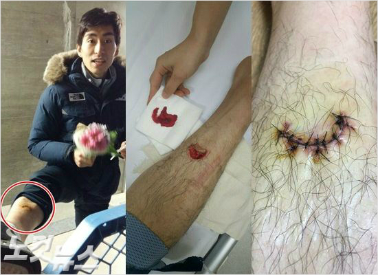 '아직실밥도안풀었는데...'이승훈이23일삿포로동계아시안게임을4관왕으로마친뒤인터뷰에서취재진의요청에오른정강이부상부위를보여주고있다.가운데사진은지난10일부상직후응급실에실려갈당시모습,오른쪽은8바늘을꿰맨뒤모습.(오비히로=노컷뉴스,이승훈)