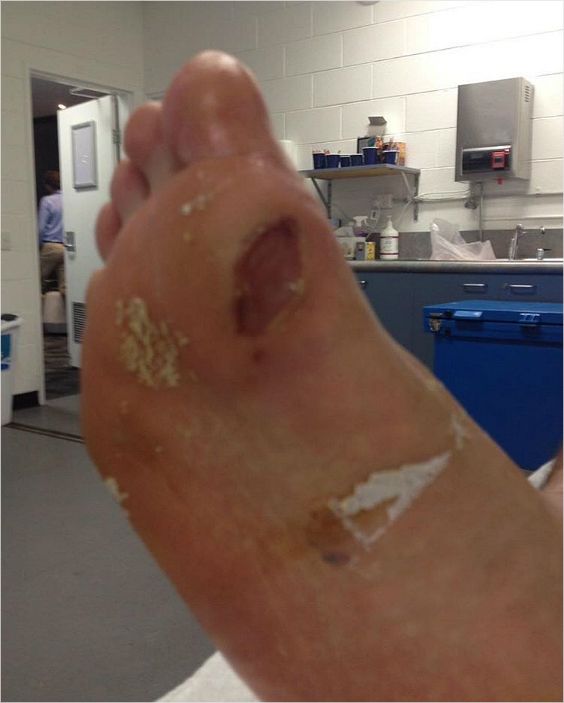 상처 투성이가 된 정현의 오른발. (사진=정현 인스타그램)