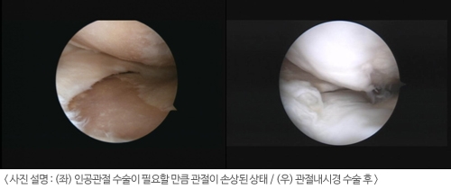 무릎 퇴행성관절염, ‘줄기세포를 이용한 재생치료’로 인공관절 수술 효과 얻는다!