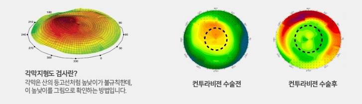 안구건조증 고민은 그만, 컨투라비전 라섹 Q&A