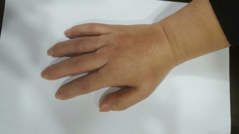 (사진=항암제 투여로 인해 혈관 속 염증이 발생한 ‘항암제 부작용 증상’의 예)