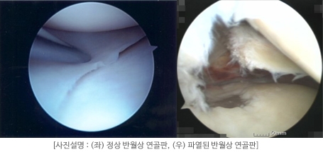 강남 연세사랑병원, "반월상 연골판 손상" 관절내시경으로 치료했는데 통증이 더 심해졌다?