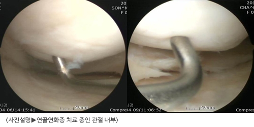 퇴행성관절염은 없는데 시큰거리는 무릎, '연골연화증' 일수도.. 줄기세포로 치료