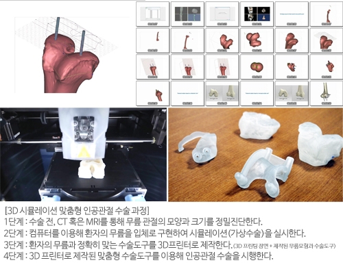 강남 연세사랑병원, '맞춤형 인공관절 수술' 자체 기술로 국내화 시켜 주목