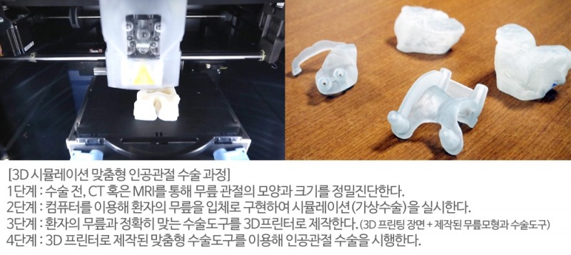 첨단 기술 도입된 '맞춤형 인공관절 수술', 정확도는 높아지고 비용은 낮아졌다