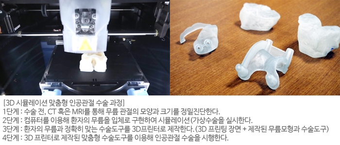 첨단 기술 도입해 정확도 높아진 '환자 맞춤형 수술, 수술 후 통증관리와 재활운동 필수