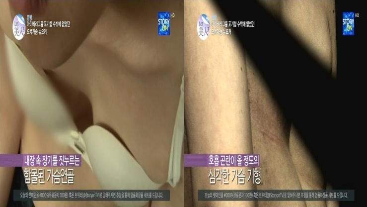 사진= 렛미인 오목가슴