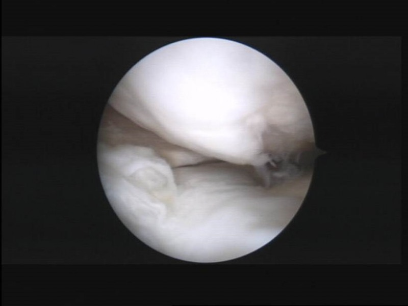 사진=수술 후 관절내시경 연골이 재생되어 하얗게 덮여있는 모습을 관찰할 수 있다.