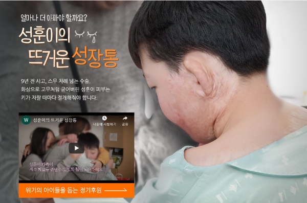 월드비전, 9년째 화상 치료 받는 아동 위한 모금 캠페인 진행
