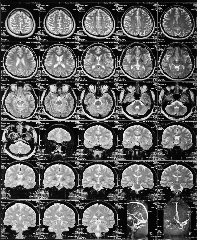 치매 유발물질을 사전 예측하는 뇌영상 검사 예측모델이 개발됐다. 사진=pixabay