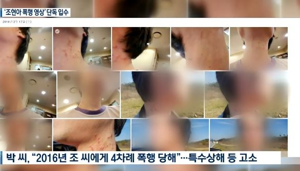 출처 : 조현아 남편 몸에 보이는 끔직한 자국들 / 케이비에스 방송캡쳐