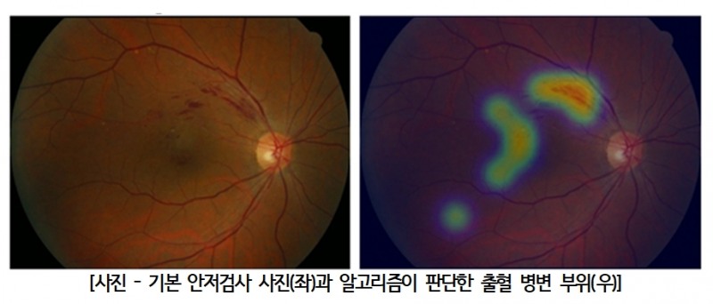 [연구] 눈 건강 이상 여부, 이제 딥러닝 알고리즘이 알려준다