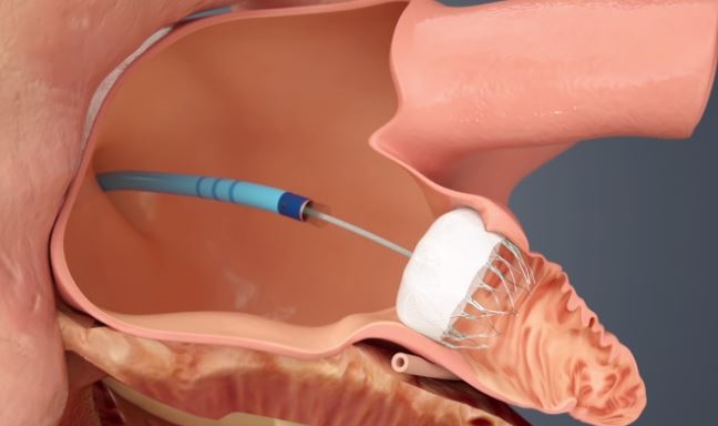 좌심방에 진입한 카테터가 좌심방이에 폐색기구를 넣어 펼쳐 메꾸는 모식도