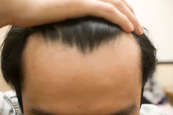 탈모로 스트레스 받는 2030 "꾸준한 치료가 약"