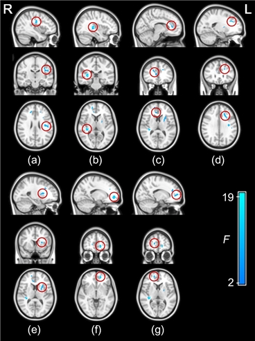 그림. 수면무호흡증 환자에서 대뇌백질이 손상된 부위를 표시했다.
