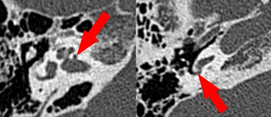 좌측은 공동성 이경화증, 우측은 정원공의 침범이 있는 진행성 이경화증의 술전 CT 검사 소견으로, 비교적 간단한 CT 검사를 통해, 공동성 이경화증 및 정원공 침범 여부를 진단할 수 있다.