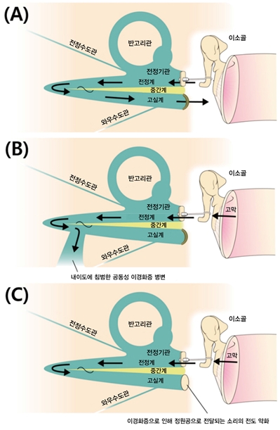 그림 (A)가 등골 수술 이후의 성공적인 치료 반응을 보여주는 것에 반해, 그림 (B)의 공동성 이경화증이 있는 경우와 그림 (C)의 정원공의 침범이 있는 경우에는 소리의 비정상적인 전달 통로로 인해 치료 효과가 나쁠 수 밖에 없다. 이번 연구에서는 특별히 그림 (B)와 그림 (C)의 비정상적인 소리 전도 효과를 각각 “제 3의 창 (Third window)” 와 “단일 창 (Single window)”이라는 명칭을 통해 설명했다.