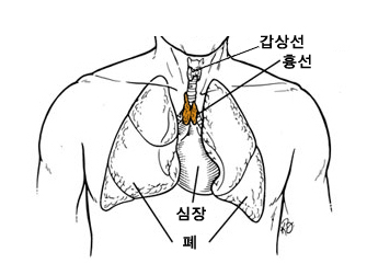 흉선암