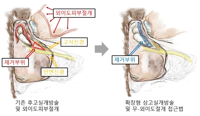 기존 수술법(좌측)은 외의도 절개 후 안면신경과 미각신경 사이에 구멍(제거부위)을 내야하는 것 때문에 수술이 까다롭고 후유증이 발생할 가능성도 높았다. 새 수술법(우측)은 수술시 구멍을 내는 부위(파란색 영역)가 신경과 거리를 유지하기 때문에 기존 수술법보다 안전하게 수술 가능하다.