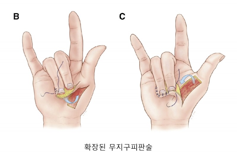 설명: 확장된 무지구 피판술은 피판부위를 넓혀 다발성 손가락 절단의 재건을 돕는다.  