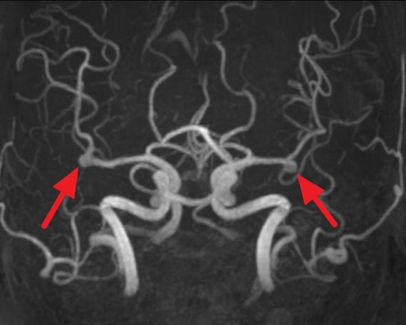 뇌동맥류, 최근 5년간 환자의 50%가 40~60대 여성... 특히 주의해야