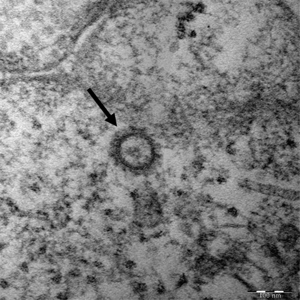코로나19 바이러스(SARS-CoV-2)의 전자현미경 사진/자료=질병관리본부
