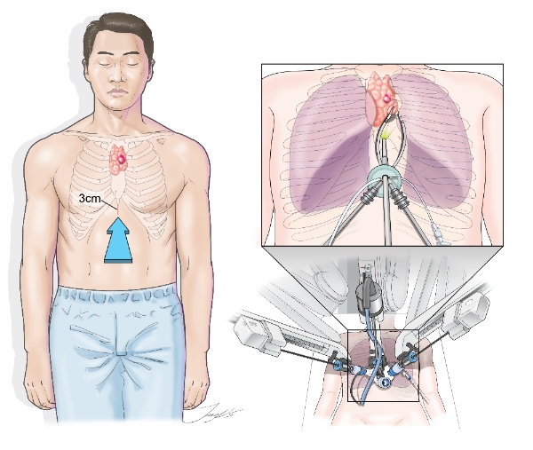 복부 통한 로봇 단일공 흉선 절제술(고려대구로병원 제공)