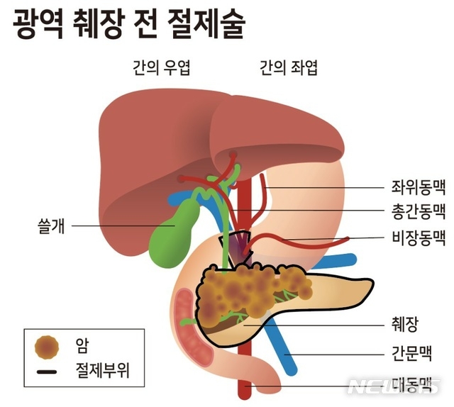 온종합병원, 췌장암 말기 혈관합병절제술로 암세포 완전 제거