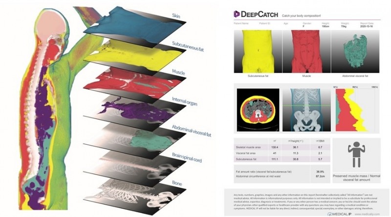 딥캐치를 통해 분할된 전신 체성분(좌) 및 딥캐치를 통해 생성된 자동 분석 리포트(우)