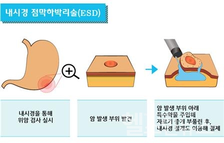 강동경희대학교병원제공,내시경점막하박리술(ESD)