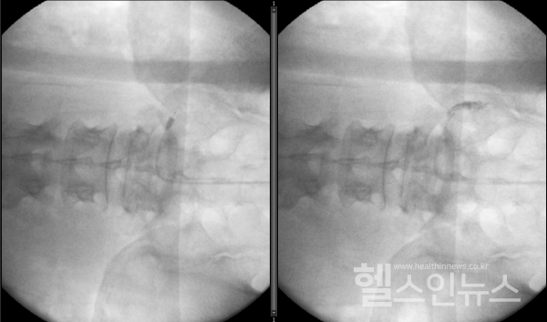 강동경희대학교병원제공,오른쪽5번요추신경공에카테터를진입시킨후풍선을확장한영상(왼쪽),이후신경공에약물을주입한영상(오른쪽).
