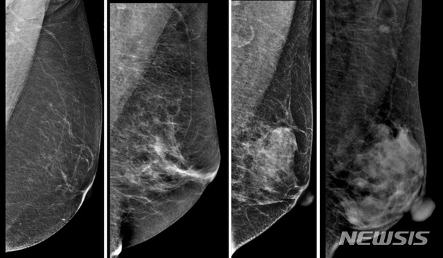 성균관의대 강북삼성병원 유방갑상선암센터 외과 김은영 교수, 코호트연구소 류승호·장유수 교수 공동 연구팀은 2015~2018년 사이 강북삼성병원에서 건강검진을 받은 35~65세 여성 8만2677명을 조사한 결과, 갱년기 비만 여성일수록 유방암의 원인이 되는 치밀 유방이 감소하는 것으로 분석됐다고 11일 밝혔다. (사진= 강북삼성병원 제공)