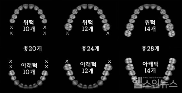 강동경희대학교병원제공,한국인은위아래큰어금니가2개씩맞물려야정상적인식사를할수있다.