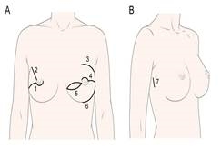 연세암병원, 국내 첫 유방암 로봇수술 200례 달성