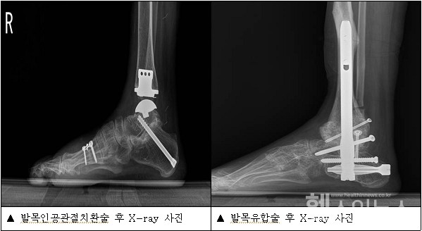 발목인공관절치호나술과발목유환술후X-레이사진