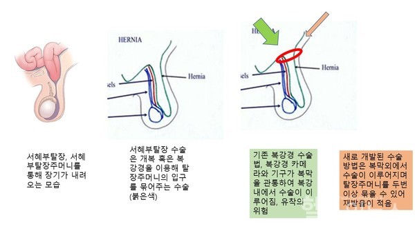 서혜부탈장복강경수술설명그림