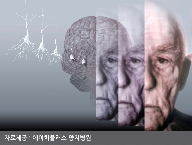 알츠하이머 참고이미지 /자료제공=에이치플러스 양지병원