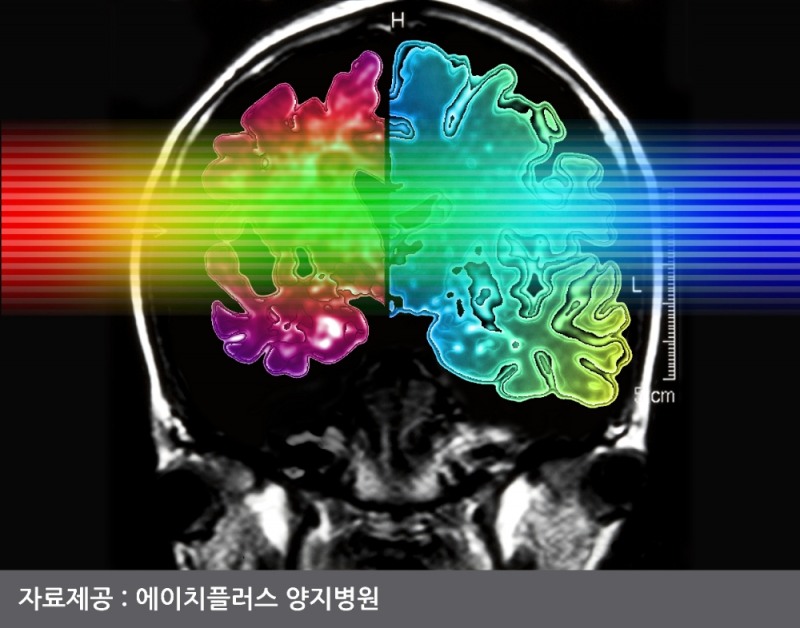 알츠하이머 참고이미지 /자료제공=에이치플러스 양지병원
