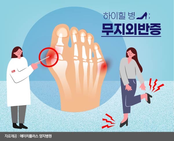 무지외반증
