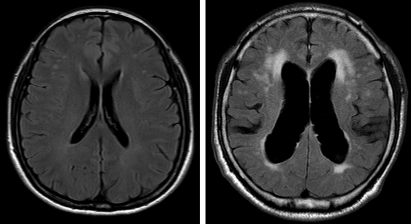 정상 뇌(왼쪽)와 정상압 수두증 환자의 뇌 MRI 비교. 사진=분당서울대병원