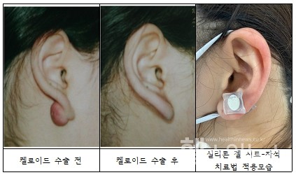 실리콘겔시트-자석병합치료적용모습