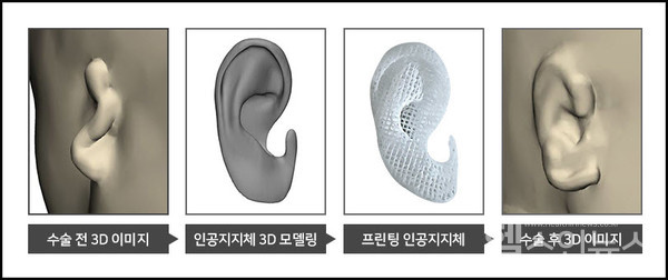 환자맞춤형귀재건용생분해성인공지지체(임플란트)예시