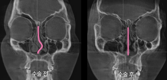 아이디병원, 코뼈골절 복원 수술 전문성 고도화…'코수술 분야 확장 본격화'