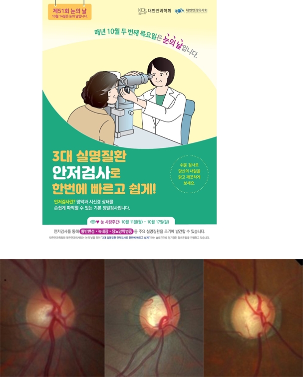 (왼쪽부터)정상, 녹내장 초기, 녹내장 말기 (사진제공=대한안과학회)