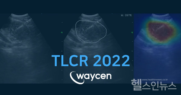 웨이센,SCIE국제학술지에AI로폐암전이판별하는연구논문게재